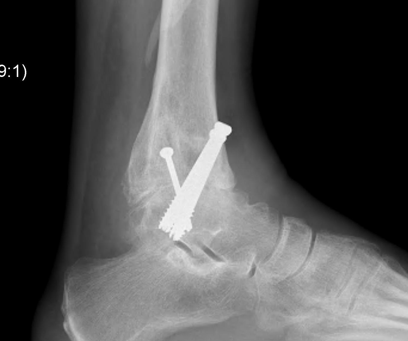Ankle Fusion Lateral